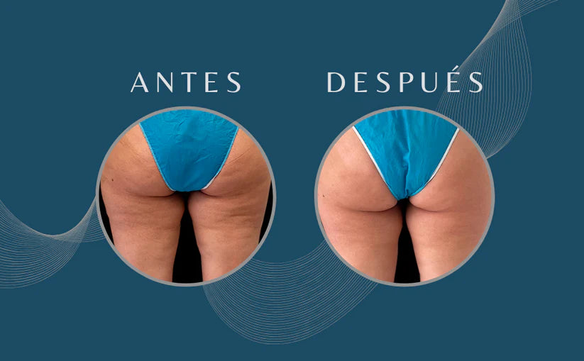 Reductor de celulitis y estrías